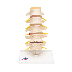 Prolapsmodel med vertebral defects